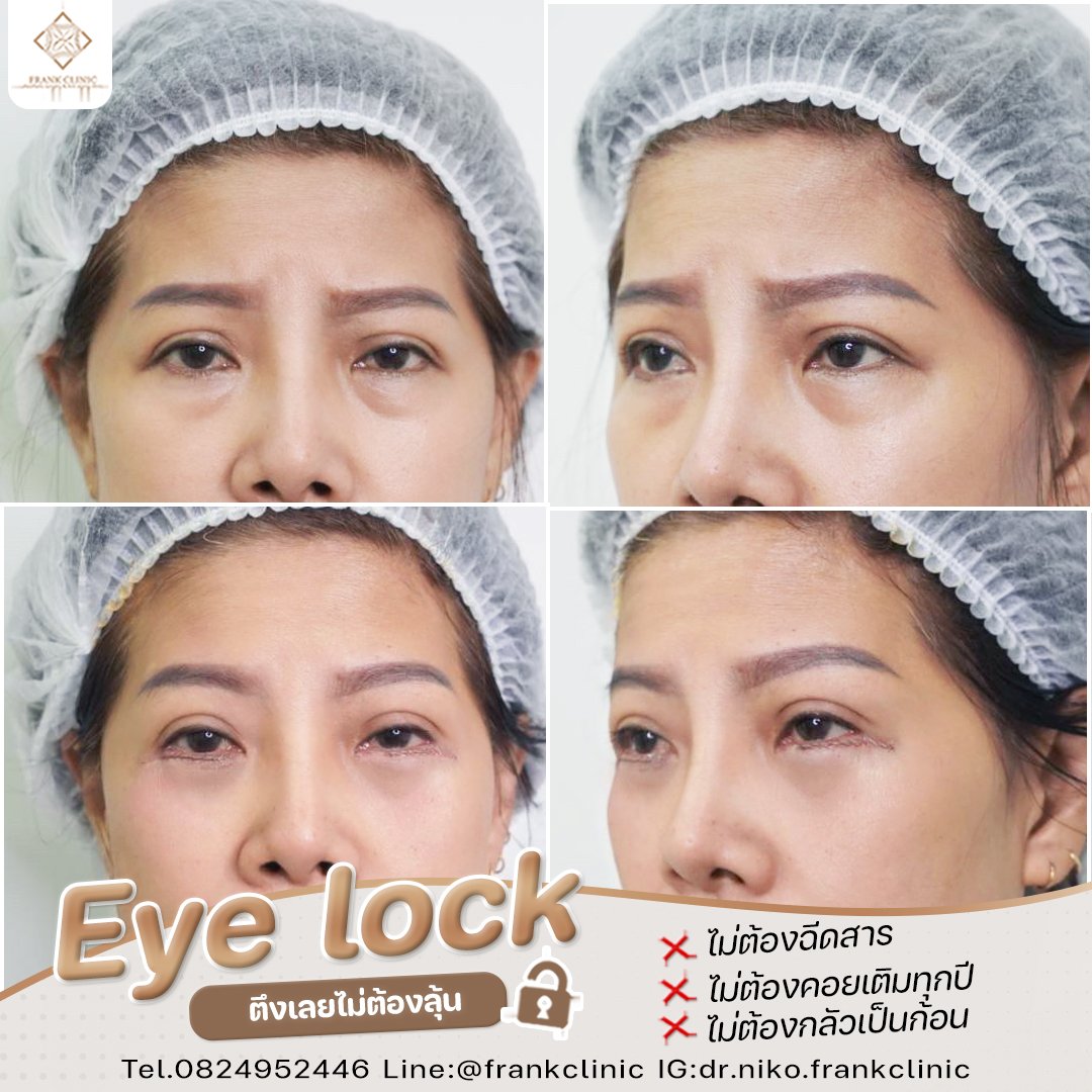Panel Eyelock รีวิว เทคนิค EYELOCK ตัดถุงใต้ตา