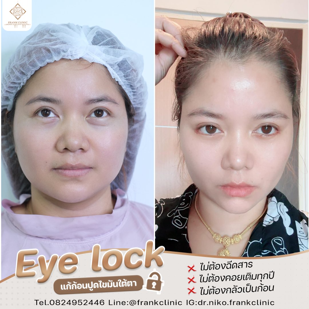 Panel Eyelock รีวิว เทคนิค EYELOCK ตัดถุงใต้ตา