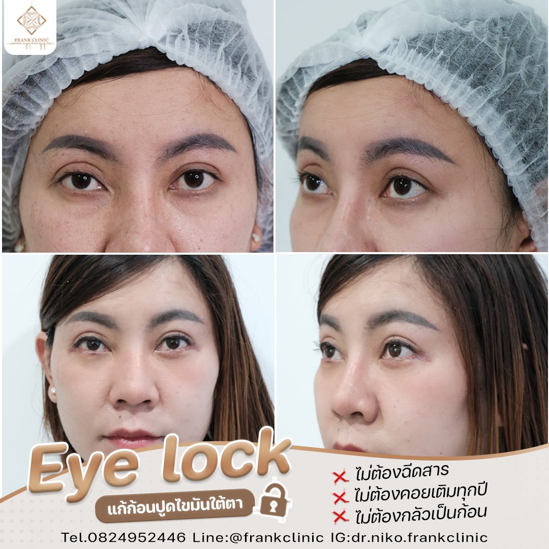 Panel Eyelock รีวิว เทคนิค EYELOCK ตัดถุงใต้ตา