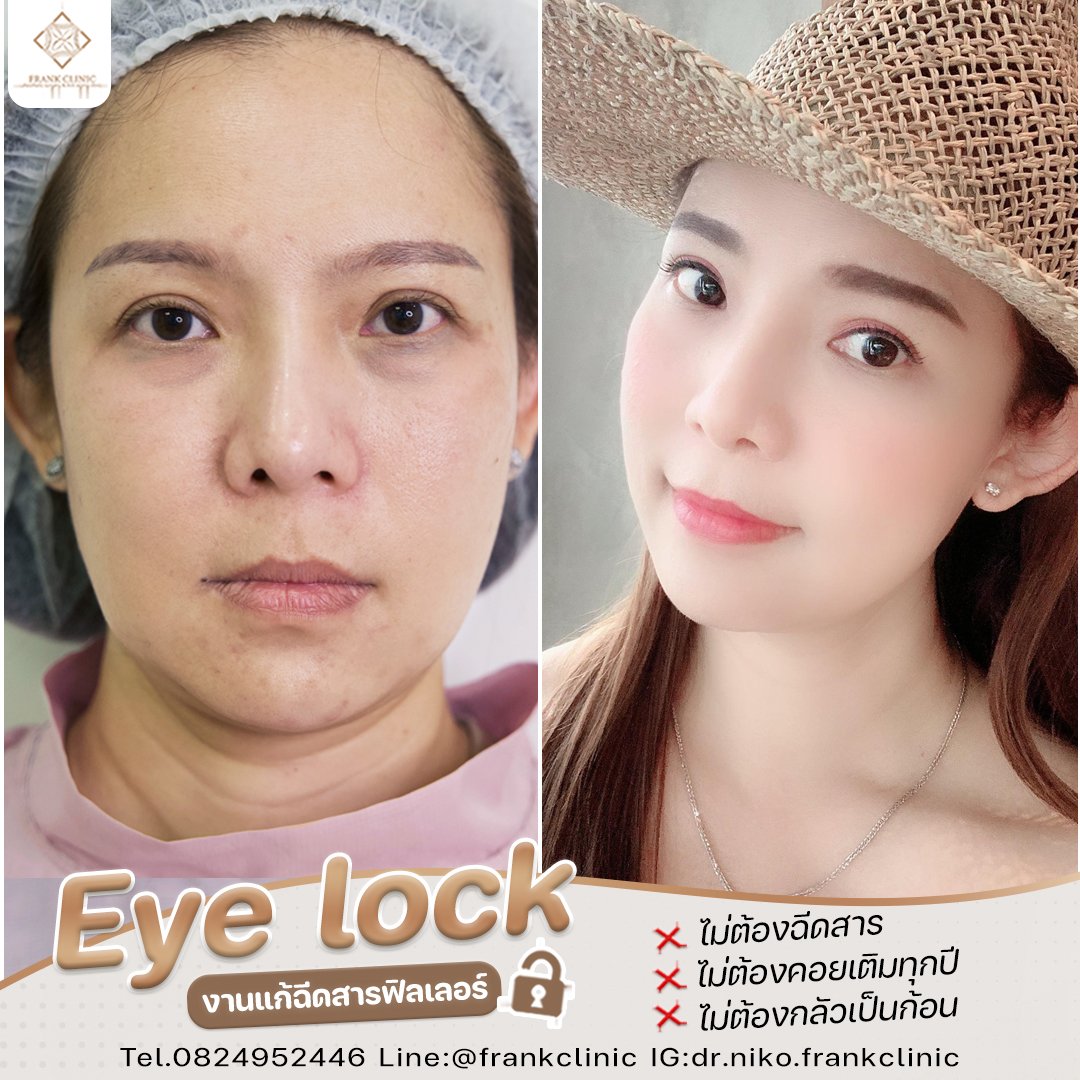Panel Eyelock รีวิว เทคนิค EYELOCK ตัดถุงใต้ตา