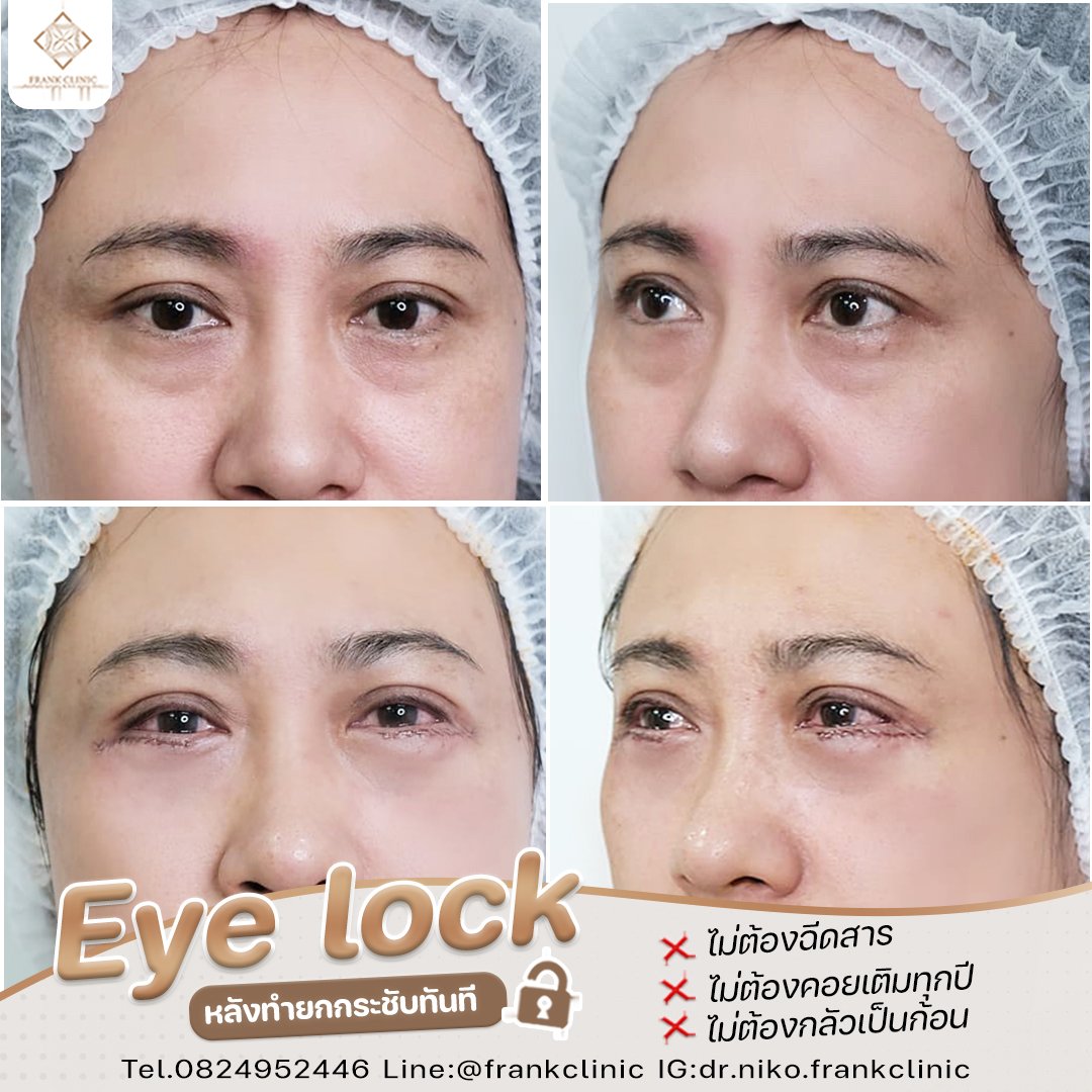 Panel Eyelock รีวิว เทคนิค EYELOCK ตัดถุงใต้ตา