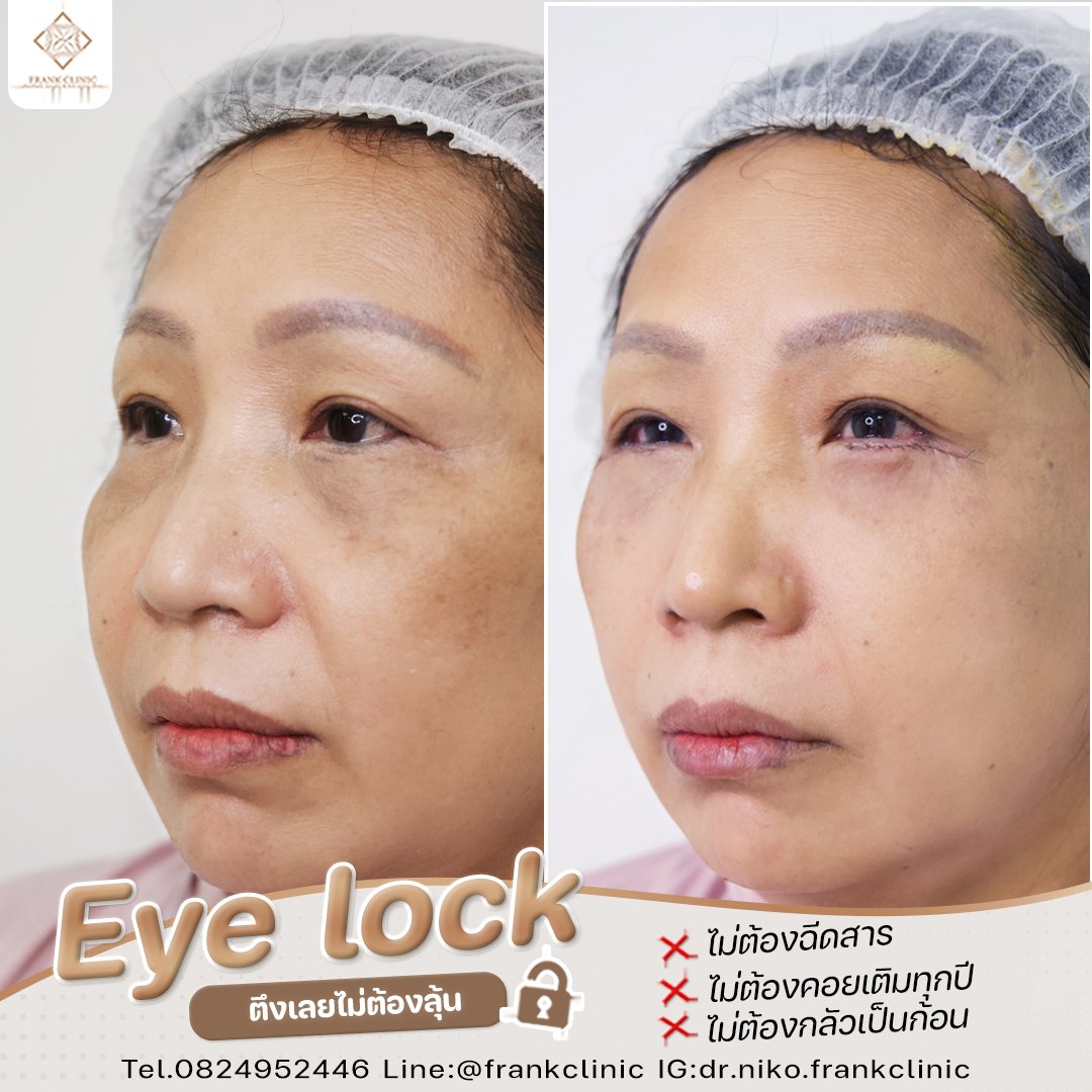 Panel Eyelock รีวิว เทคนิค EYELOCK ตัดถุงใต้ตา