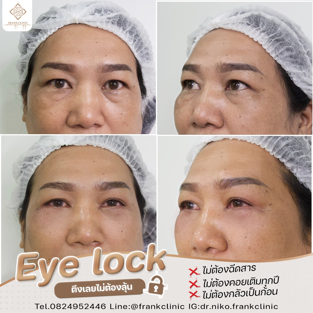 Panel Eyelock รีวิว เทคนิค EYELOCK ตัดถุงใต้ตา