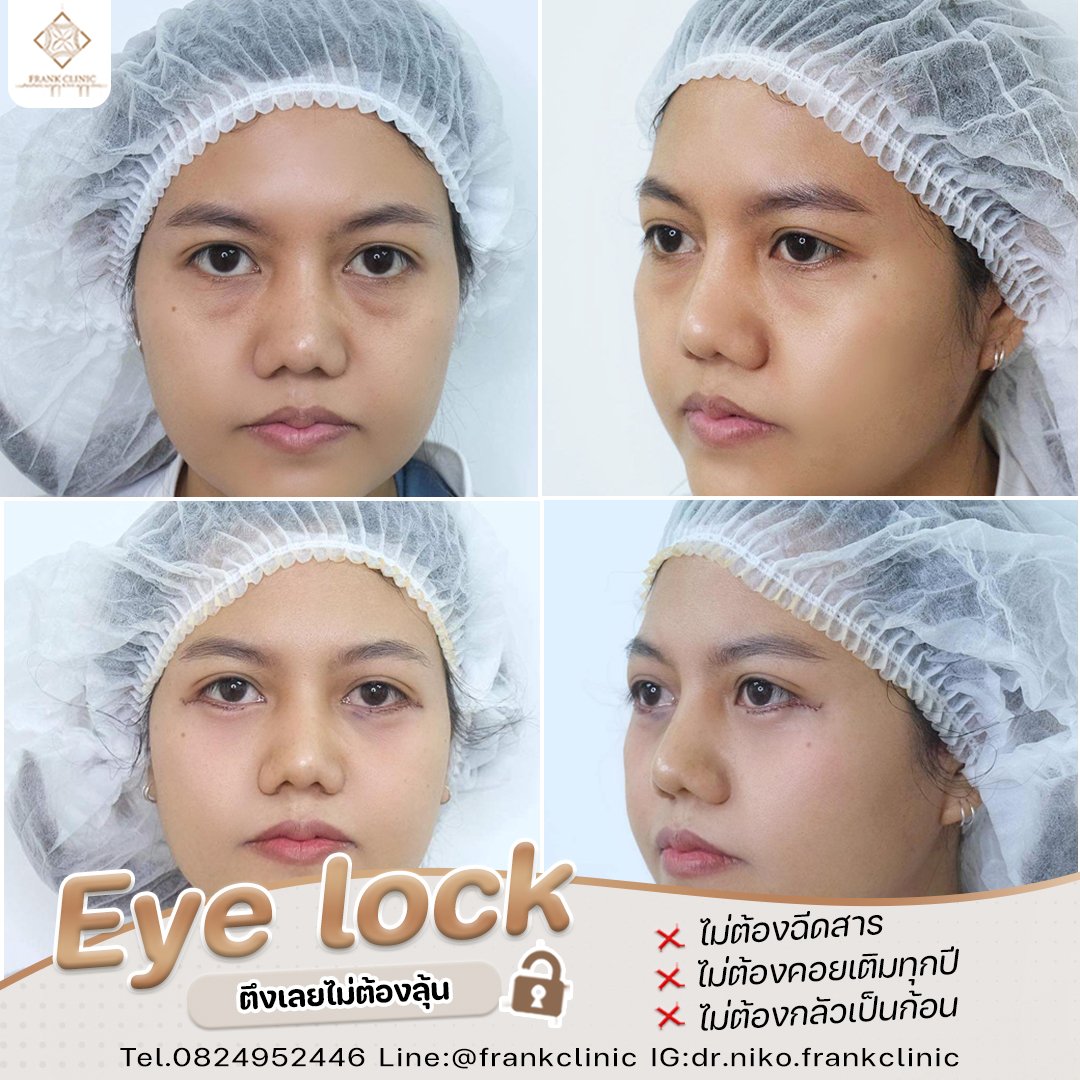 Panel Eyelock รีวิว เทคนิค EYELOCK ตัดถุงใต้ตา