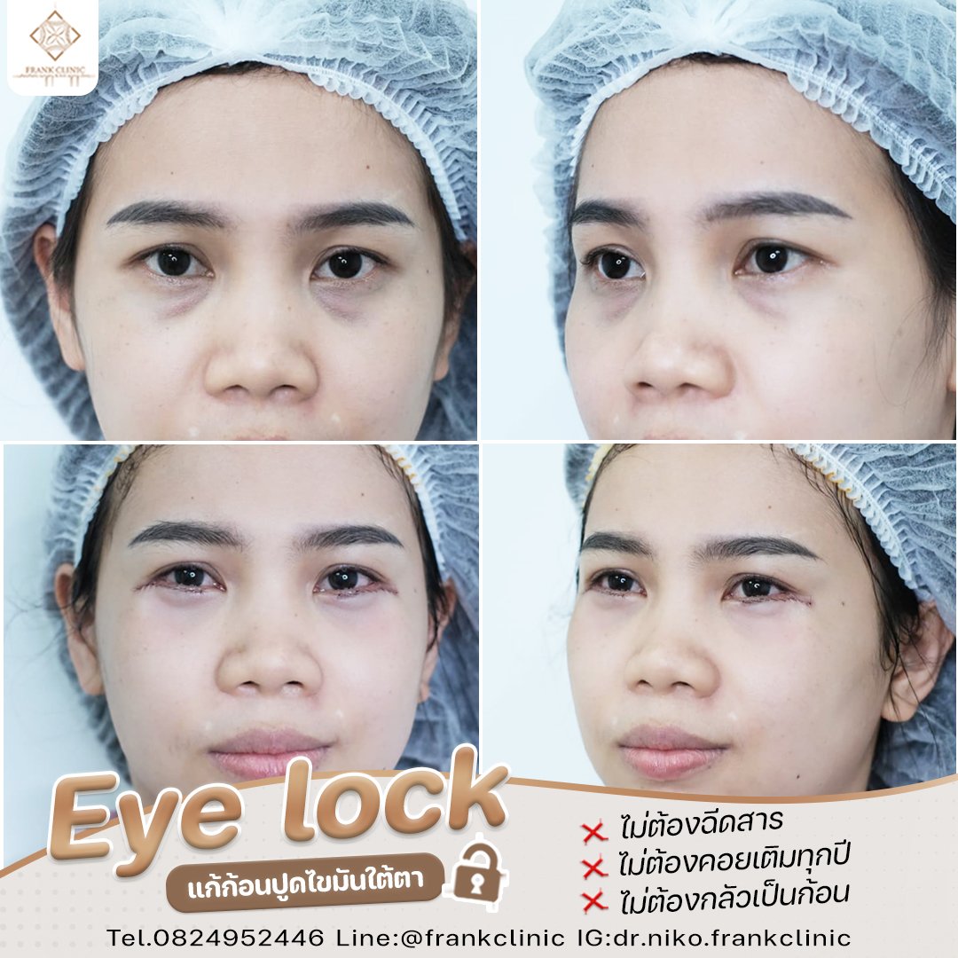 Panel Eyelock รีวิว เทคนิค EYELOCK ตัดถุงใต้ตา