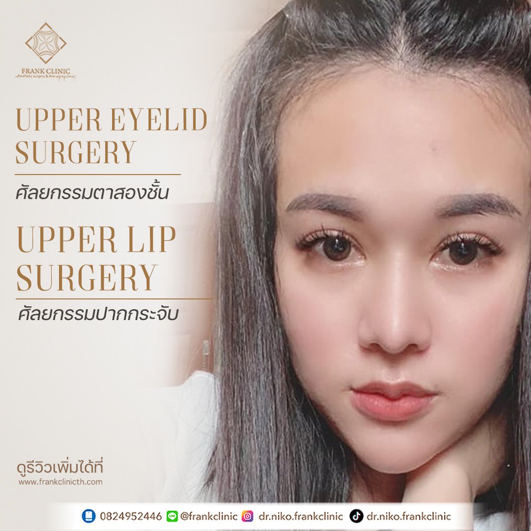 รีวิว ศัลยกรรม ปากกระจับ 2 (Lip surgery)