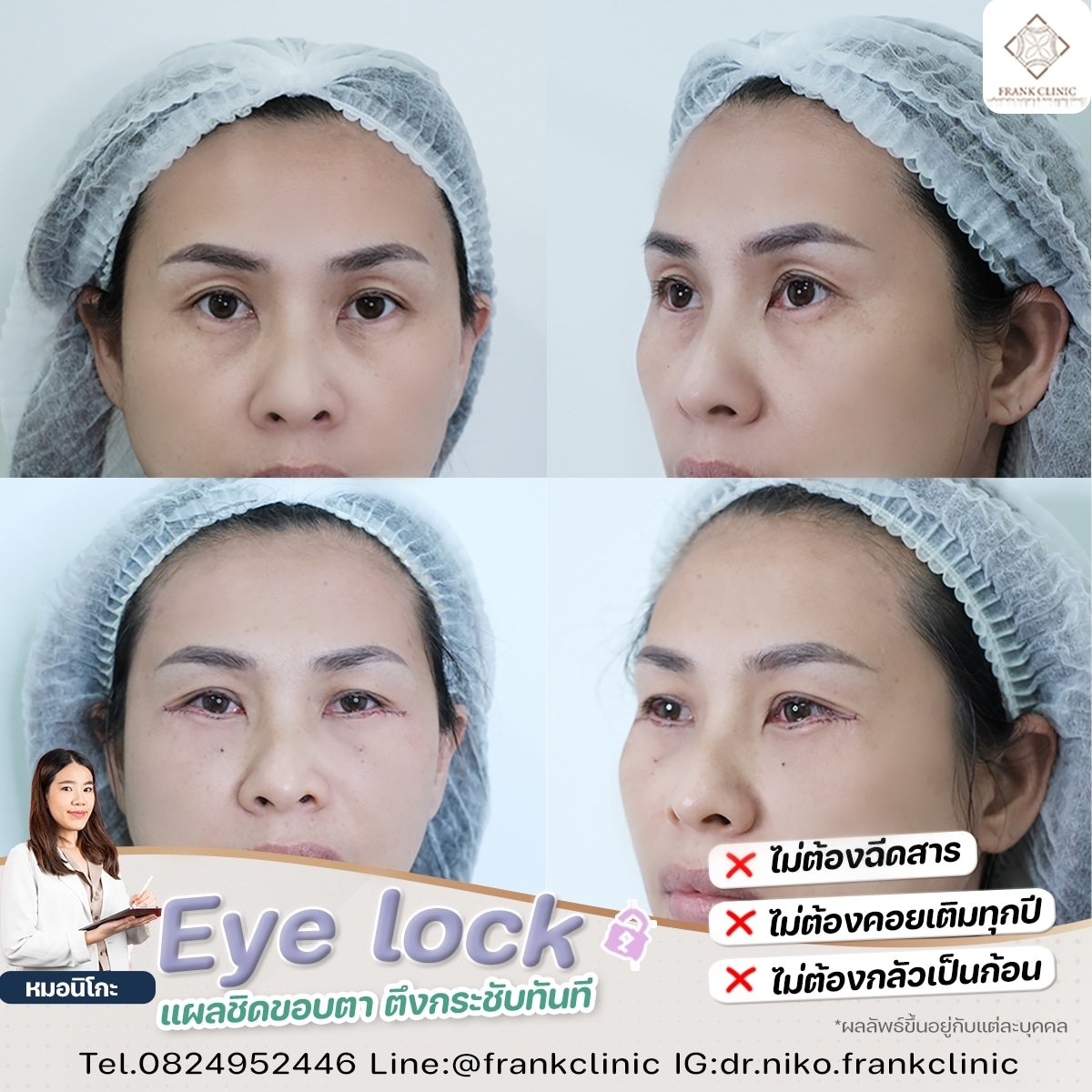 Panel Eyelock รีวิว เทคนิค EYELOCK ตัดถุงใต้ตา