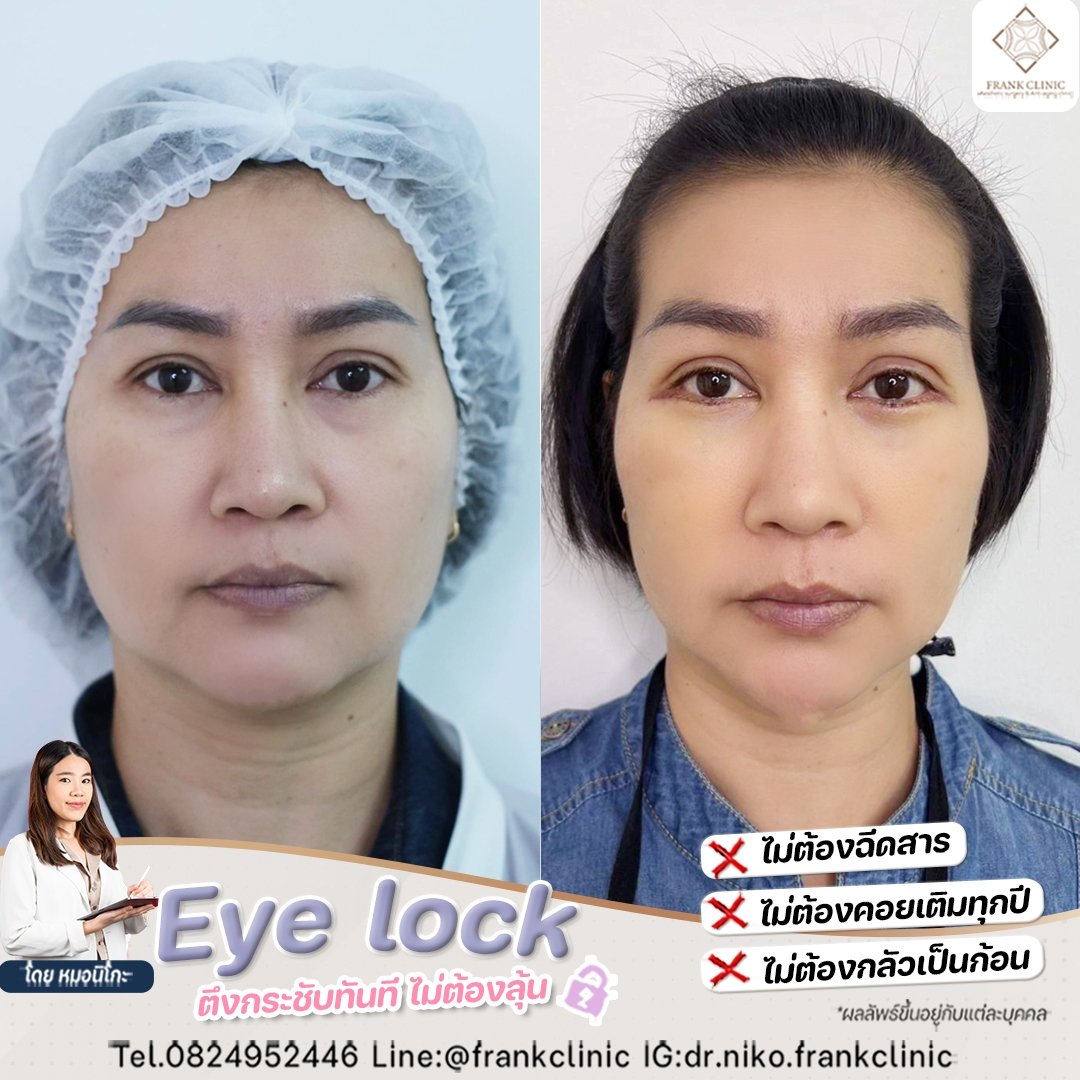 Panel Eyelock รีวิว เทคนิค EYELOCK ตัดถุงใต้ตา