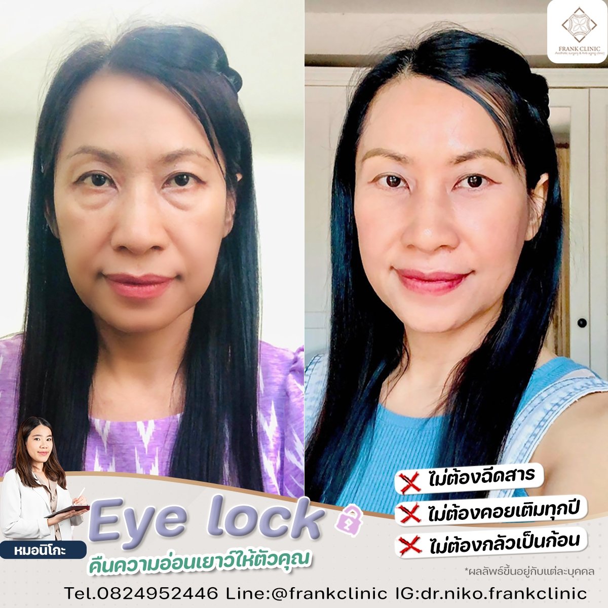 Compressor Eyelock รีวิว เทคนิค EYELOCK ตัดถุงใต้ตา