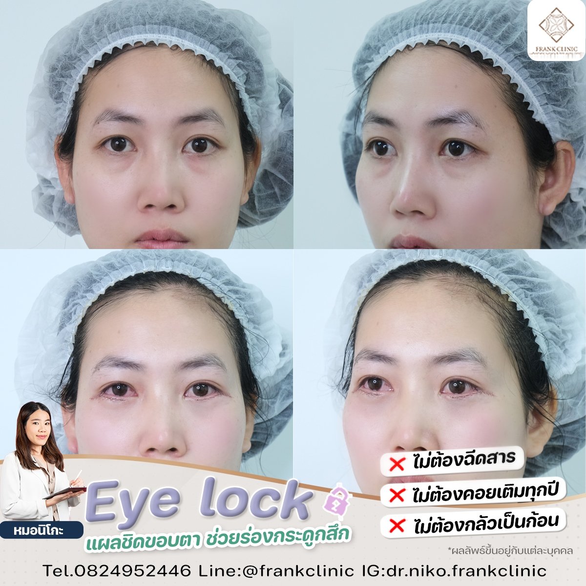 Panel Eyelock รีวิว เทคนิค EYELOCK ตัดถุงใต้ตา