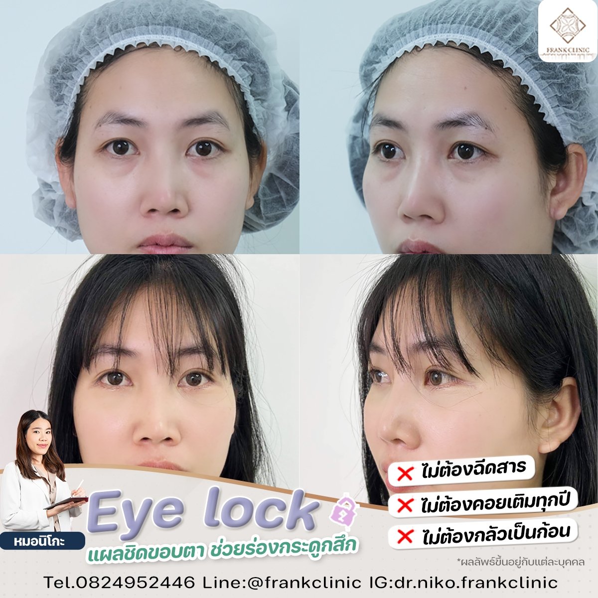 Compressor Eyelock รีวิว เทคนิค EYELOCK ตัดถุงใต้ตา