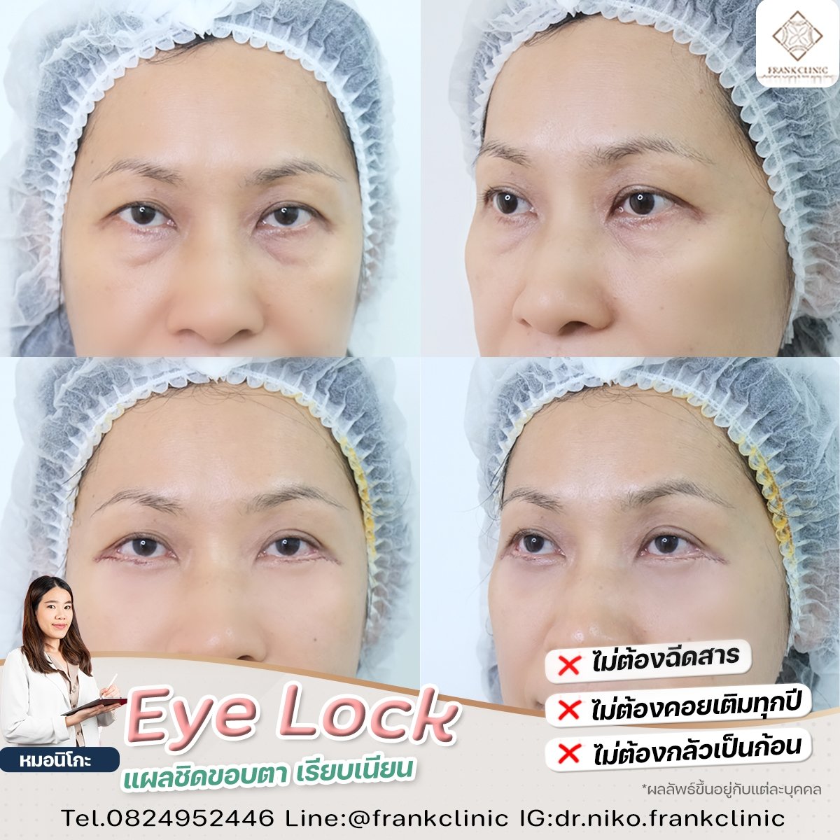Panel Eyelock รีวิว เทคนิค EYELOCK ตัดถุงใต้ตา