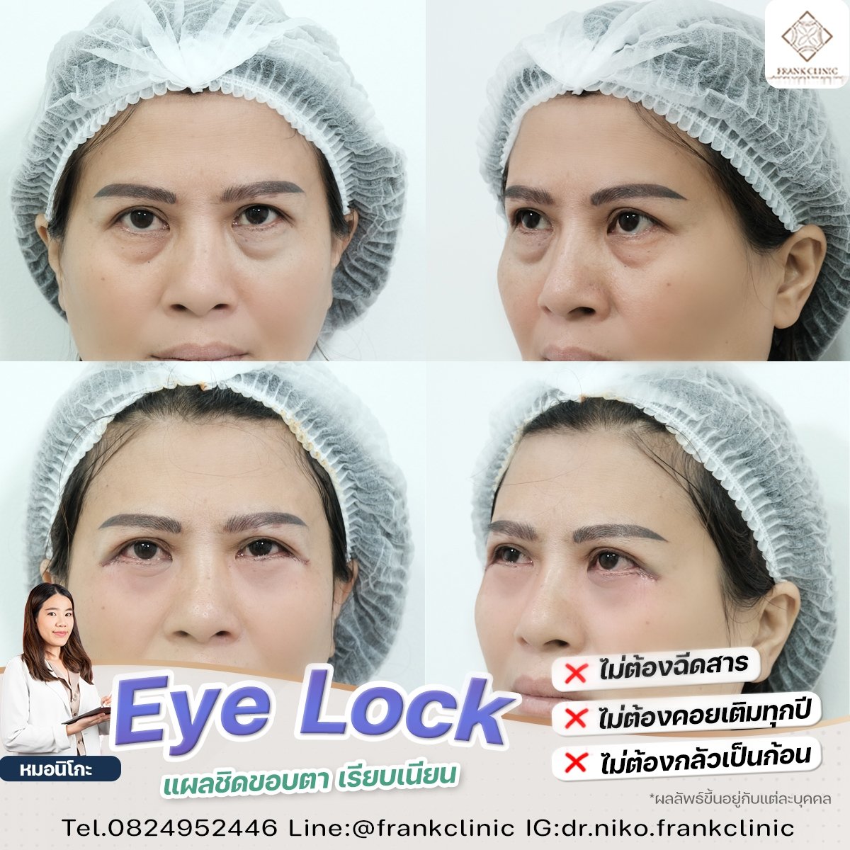 Panel Eyelock รีวิว เทคนิค EYELOCK ตัดถุงใต้ตา