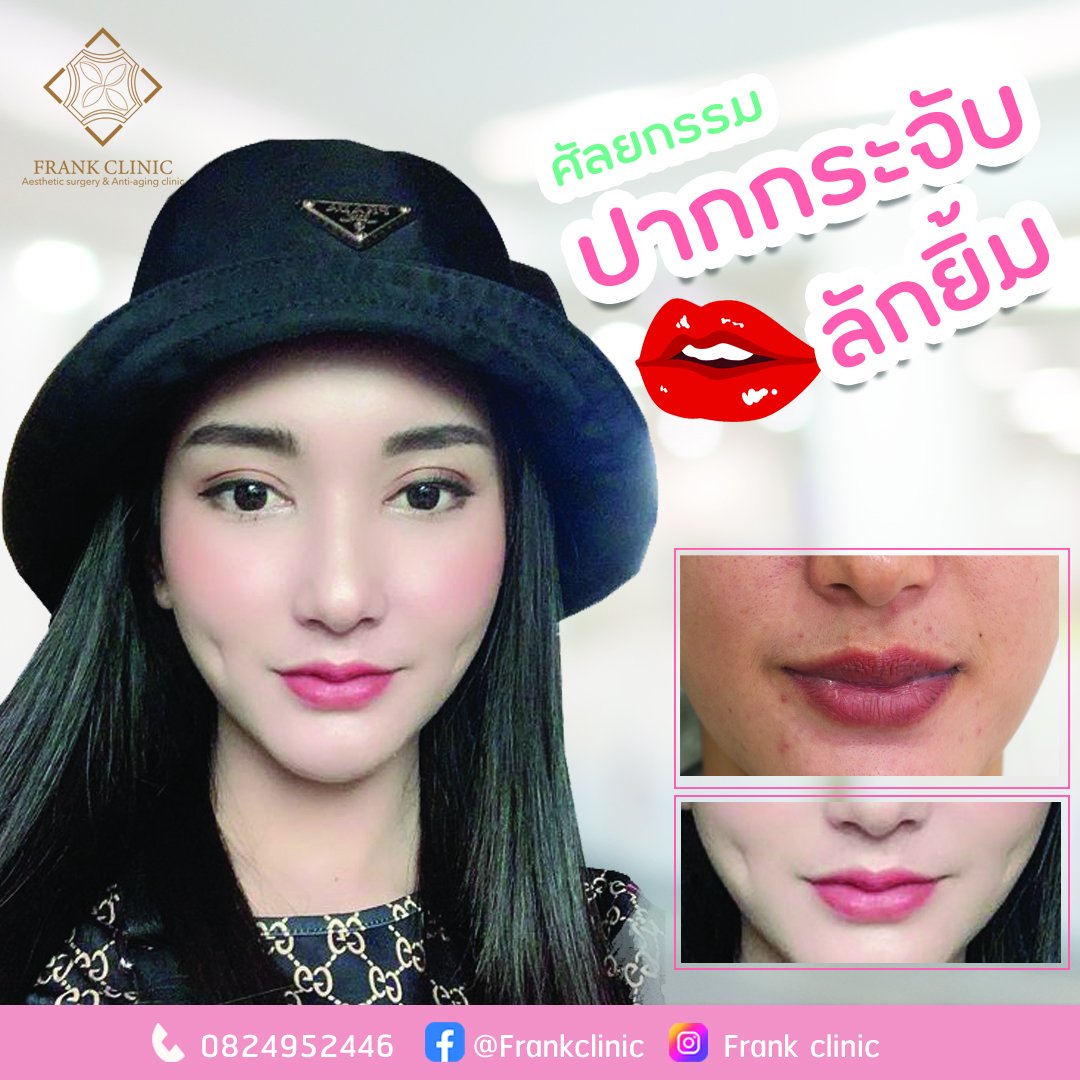 8 เหตุผลทำไมต้องทำปากกระจับกับหมอนิโกะ 8 เหตุผลทำไมต้องทำปากกระจับกับหมอนิโกะ