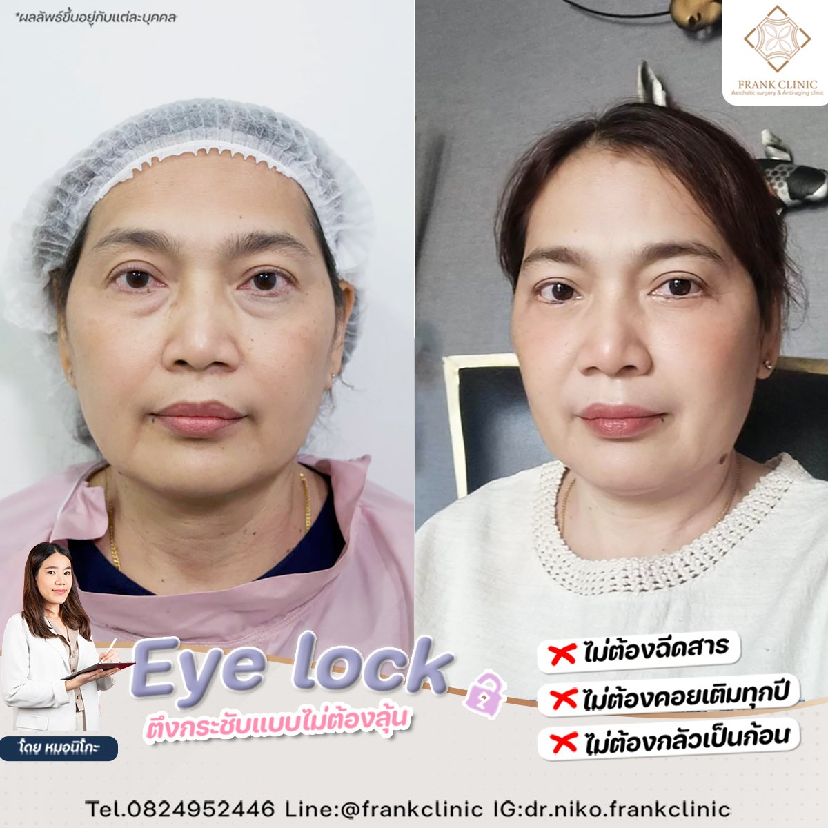 Panel Eyelock รีวิว เทคนิค EYELOCK ตัดถุงใต้ตา