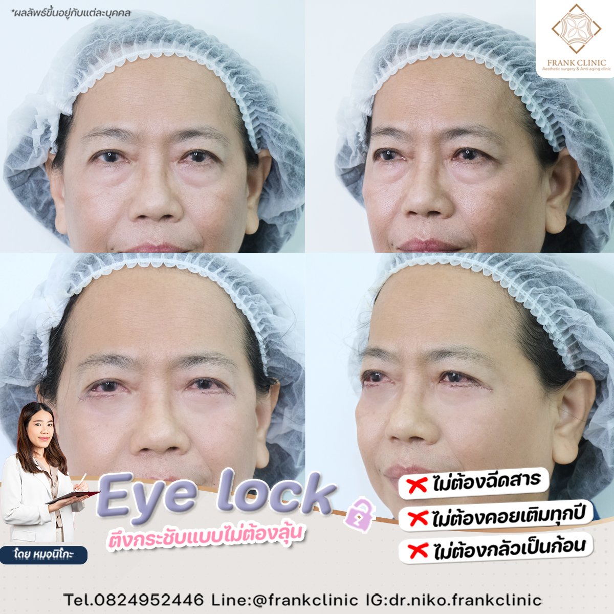 Panel Eyelock รีวิว เทคนิค EYELOCK ตัดถุงใต้ตา