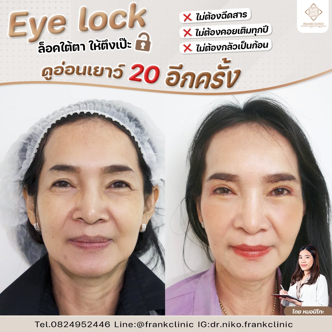 Panel Eyelock รีวิว เทคนิค EYELOCK ตัดถุงใต้ตา