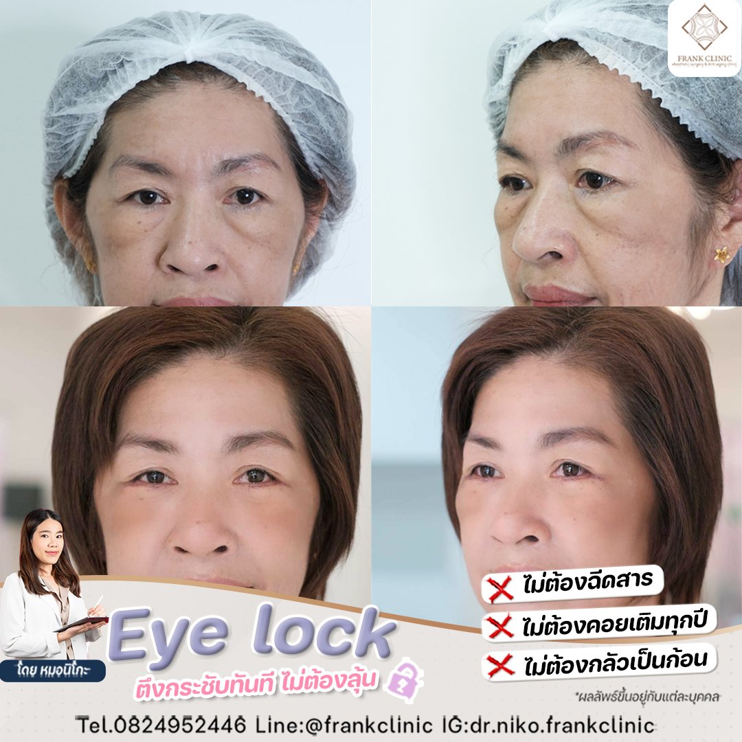 Panel Eyelock รีวิว เทคนิค EYELOCK ตัดถุงใต้ตา