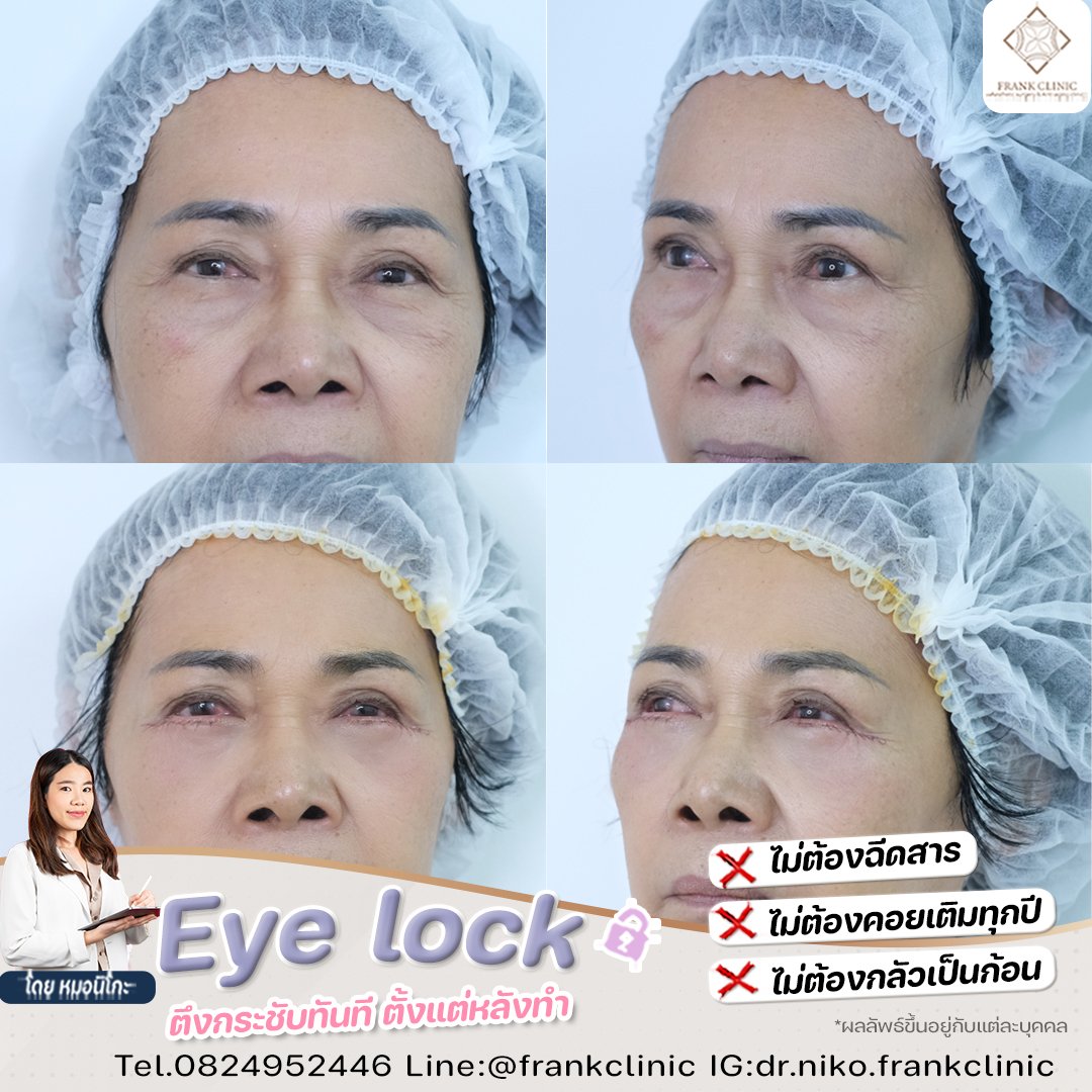 Panel Eyelock รีวิว เทคนิค EYELOCK ตัดถุงใต้ตา
