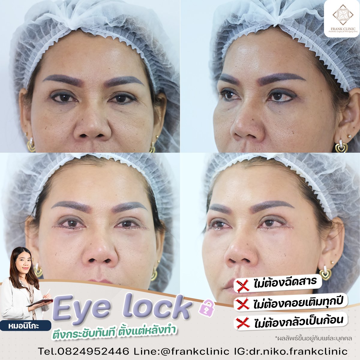 Panel Eyelock รีวิว เทคนิค EYELOCK ตัดถุงใต้ตา