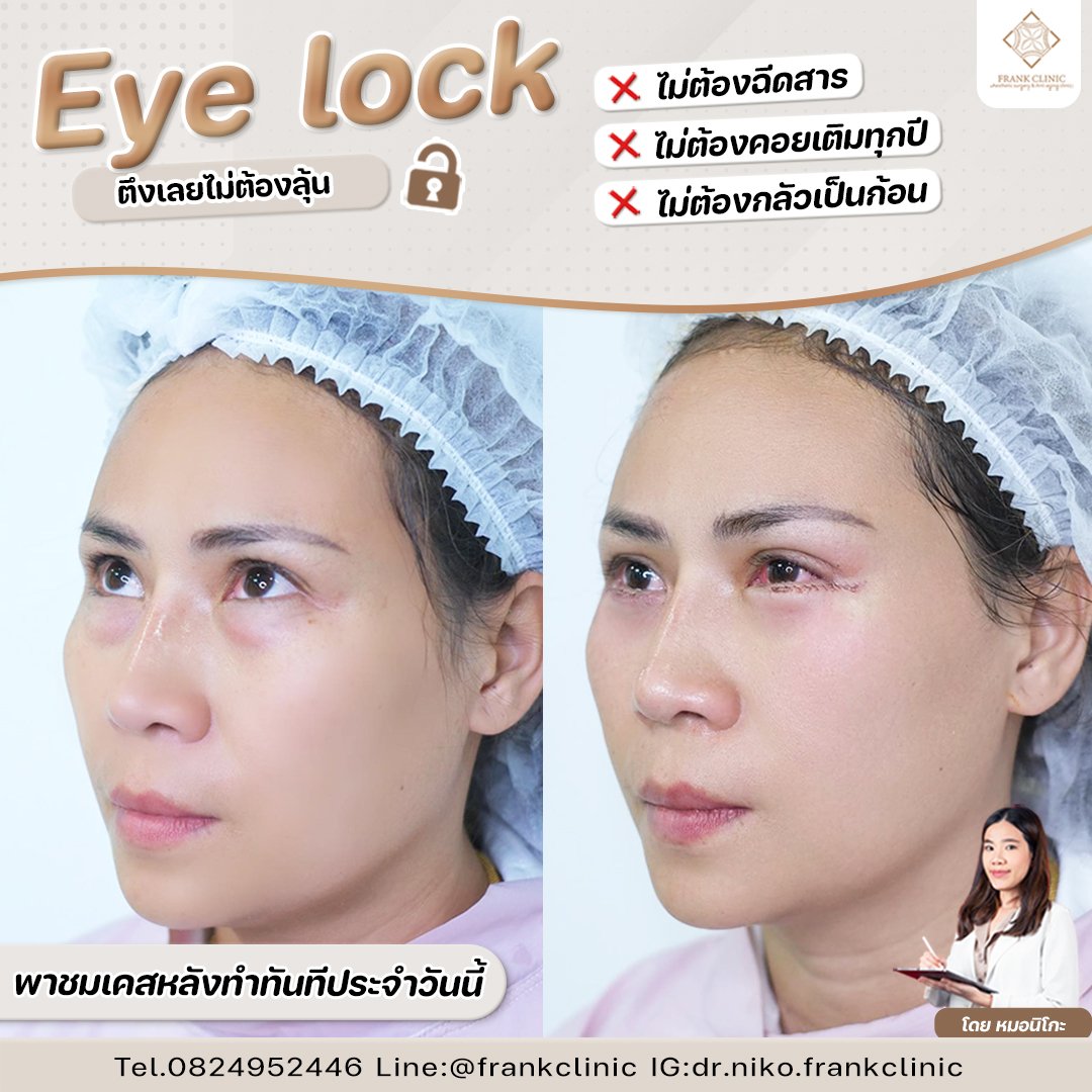 รีวิว เทคนิค EYELOCK ตัดถุงใต้ตา