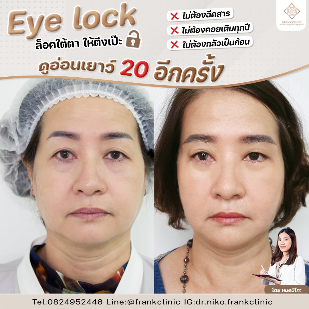 Compressor Eyelock รีวิว เทคนิค EYELOCK ตัดถุงใต้ตา