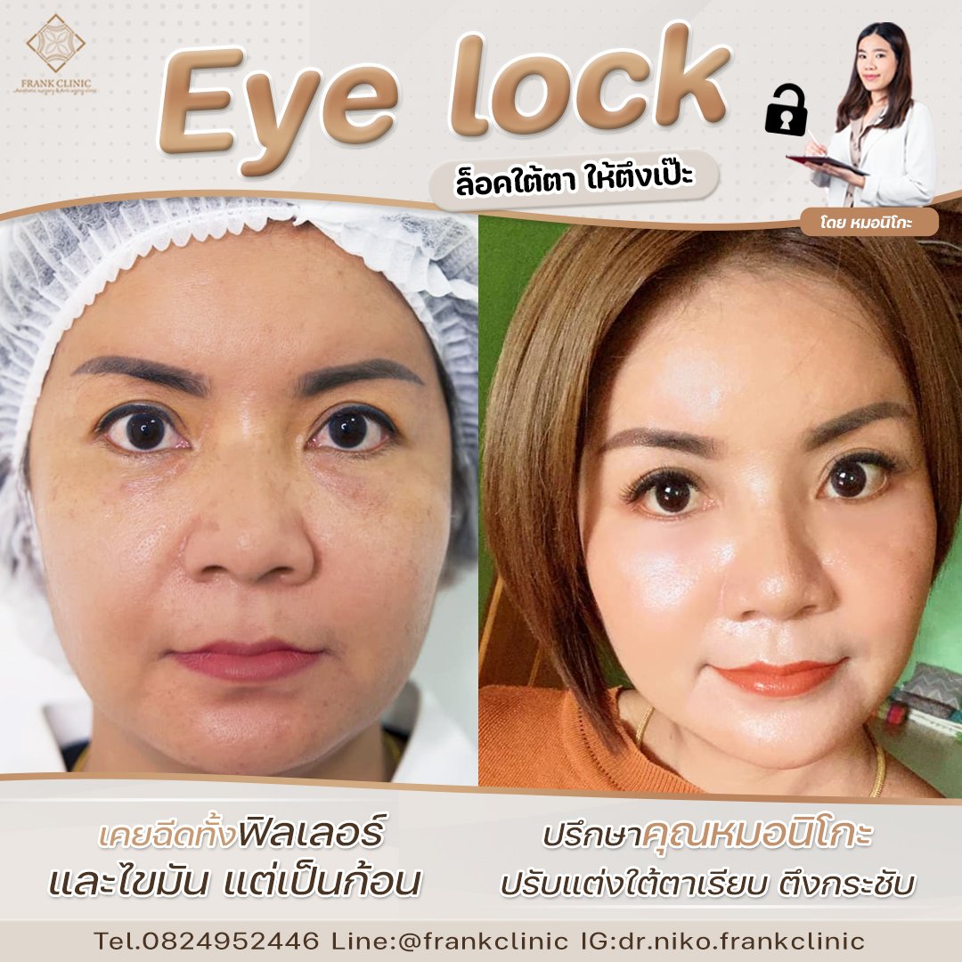 Panel Eyelock รีวิว เทคนิค EYELOCK ตัดถุงใต้ตา