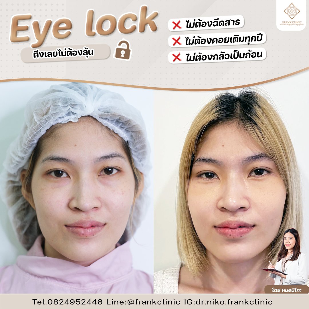 Panel Eyelock รีวิว เทคนิค EYELOCK ตัดถุงใต้ตา