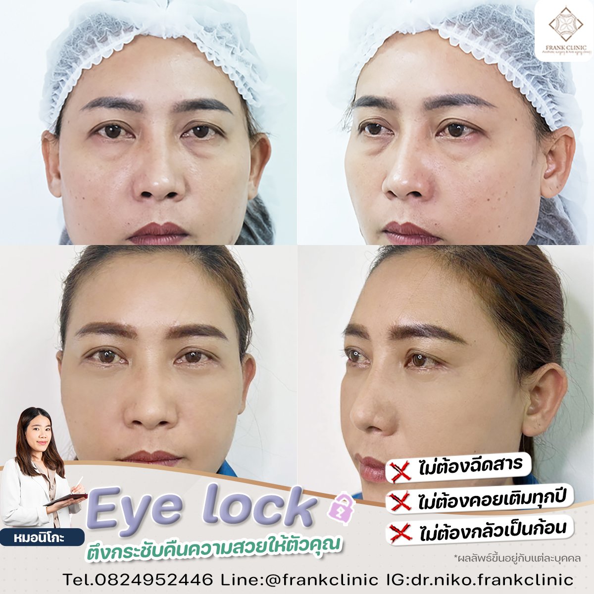 Panel Eyelock รีวิว เทคนิค EYELOCK ตัดถุงใต้ตา