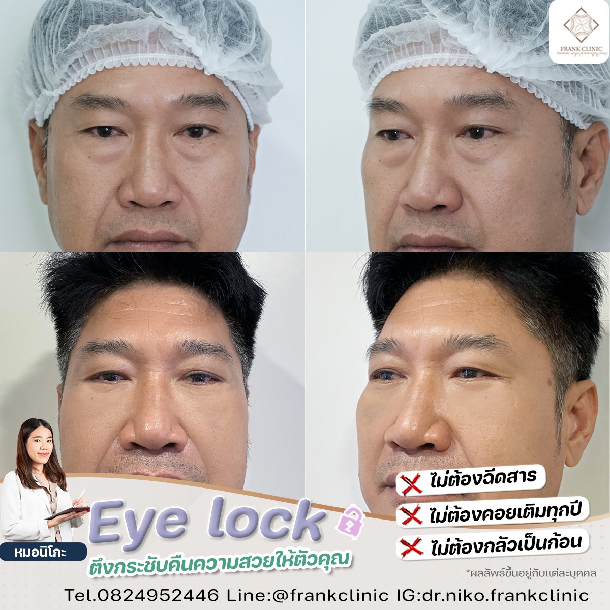 Panel Eyelock รีวิว เทคนิค EYELOCK ตัดถุงใต้ตา