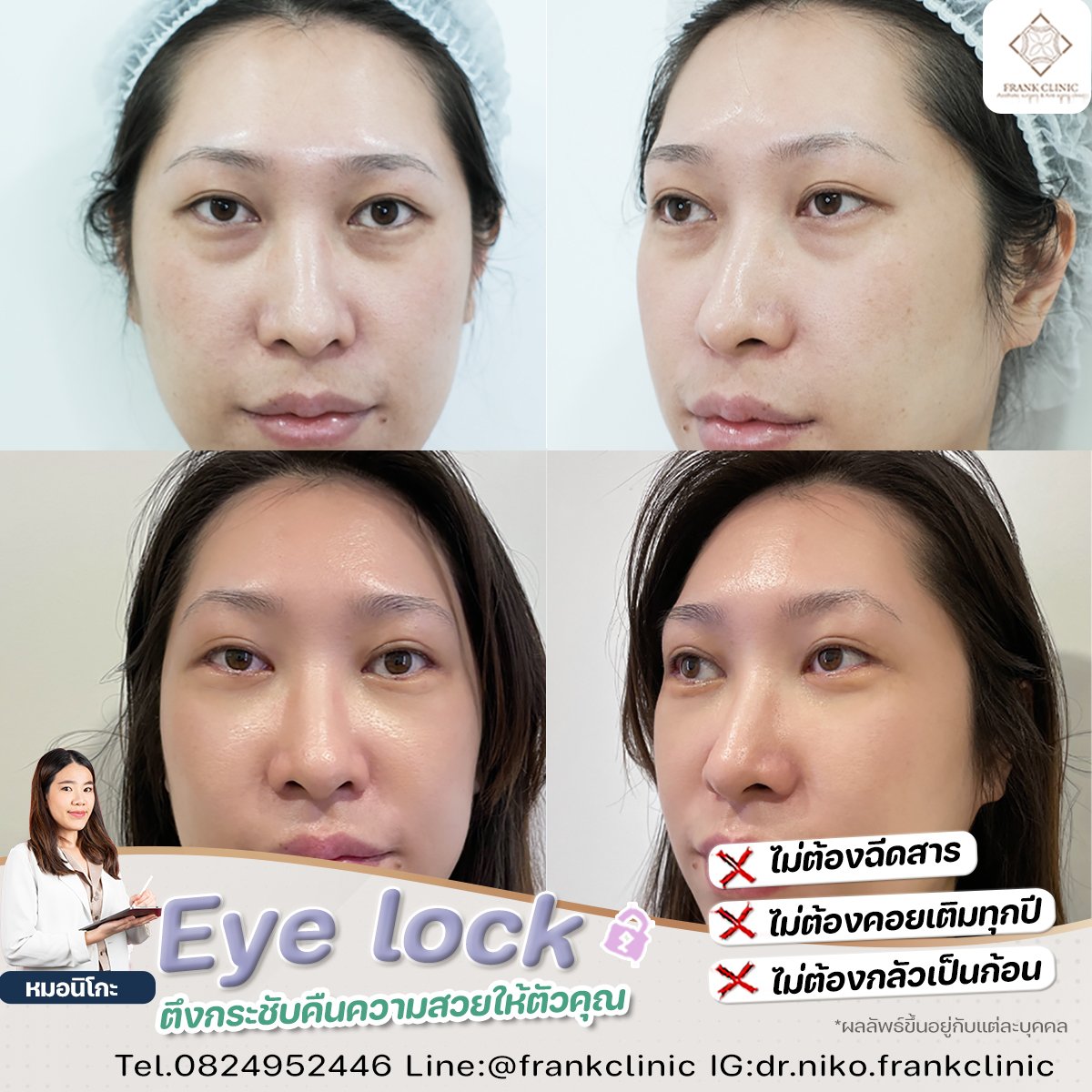 Panel Eyelock รีวิว เทคนิค EYELOCK ตัดถุงใต้ตา