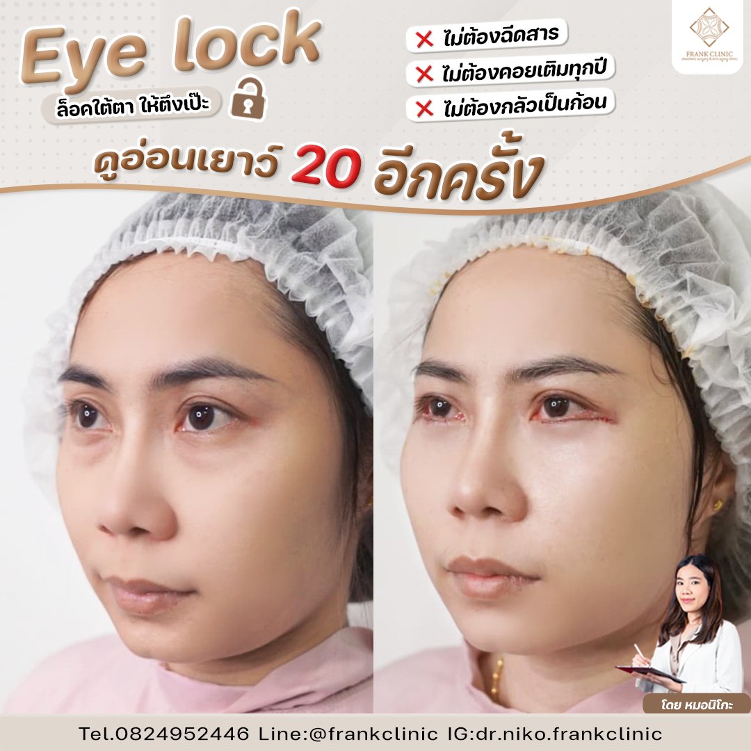 Panel Eyelock รีวิว เทคนิค EYELOCK ตัดถุงใต้ตา