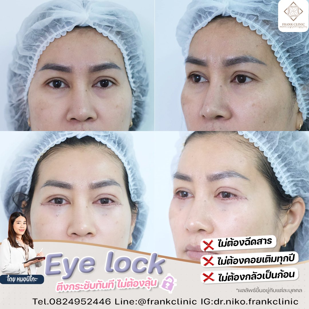 Panel Eyelock รีวิว เทคนิค EYELOCK ตัดถุงใต้ตา