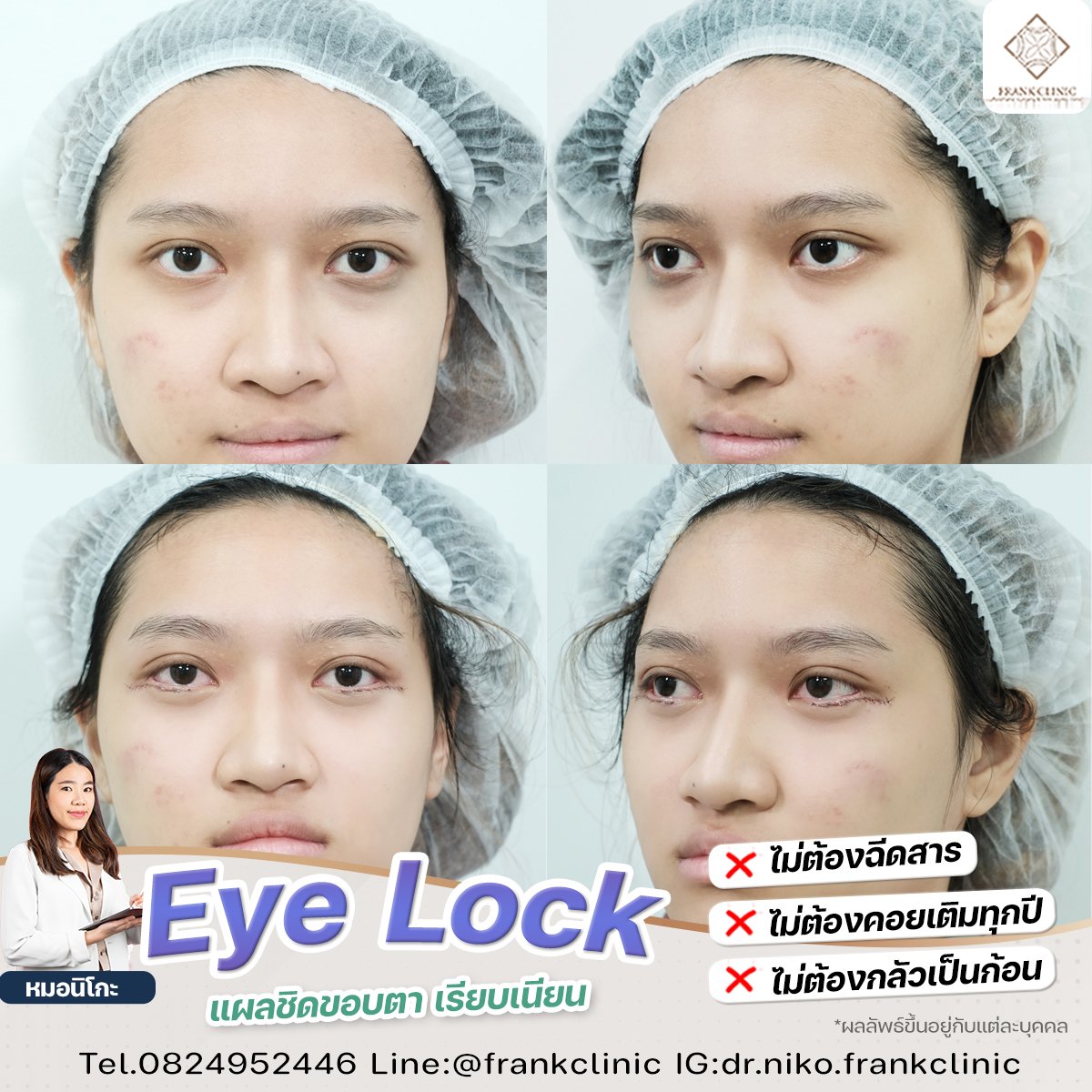 Panel Eyelock รีวิว เทคนิค EYELOCK ตัดถุงใต้ตา