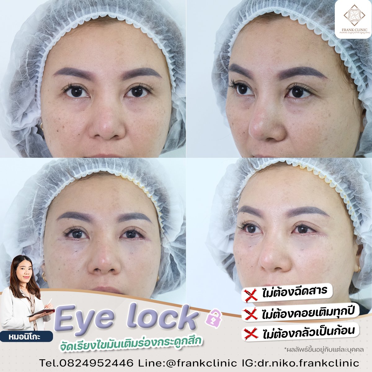 Panel Eyelock รีวิว เทคนิค EYELOCK ตัดถุงใต้ตา