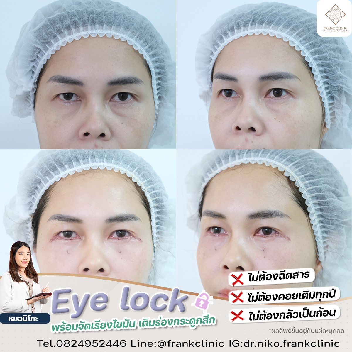 Panel Eyelock รีวิว เทคนิค EYELOCK ตัดถุงใต้ตา