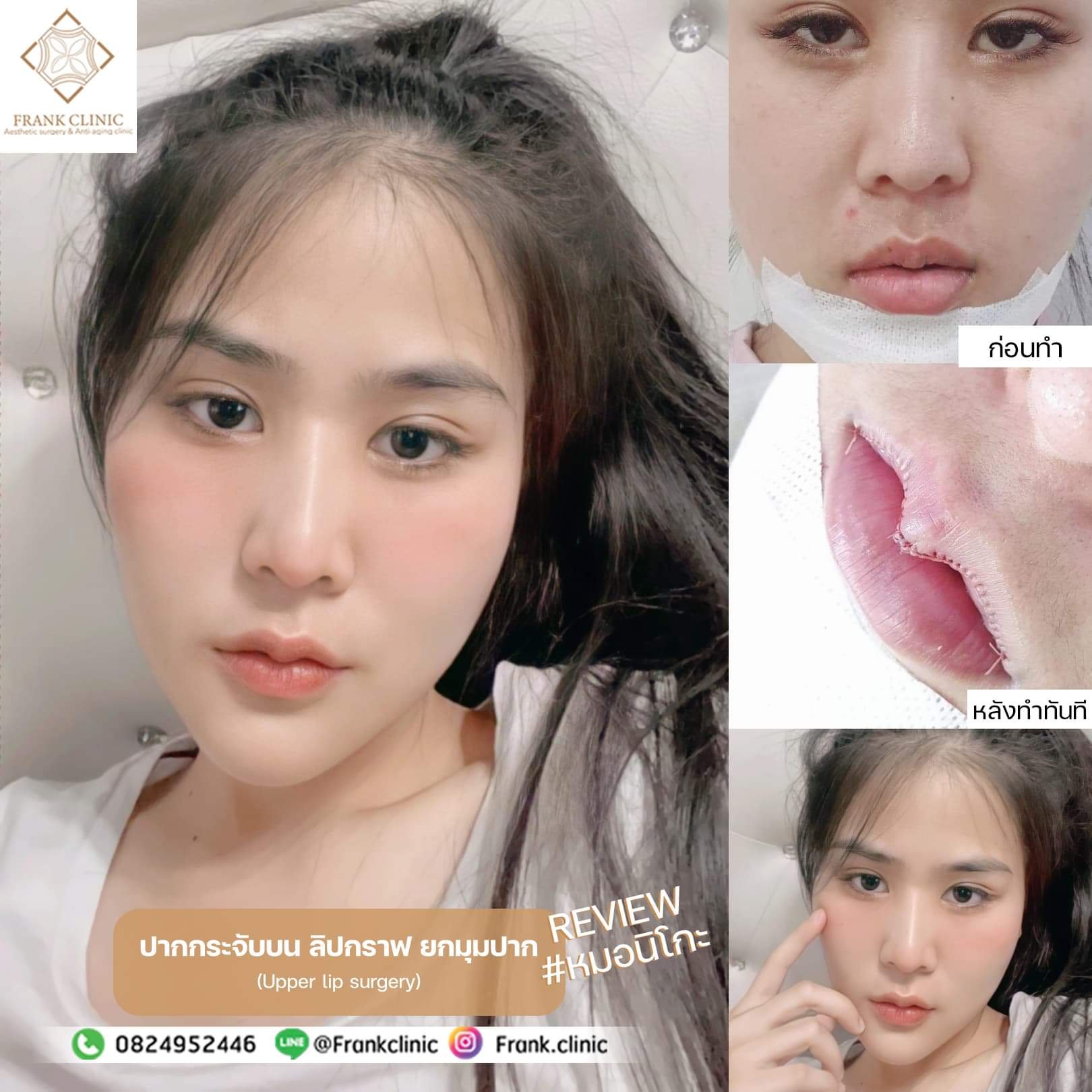 รีวิว ศัลยกรรม ปากกระจับ (Lip surgery)