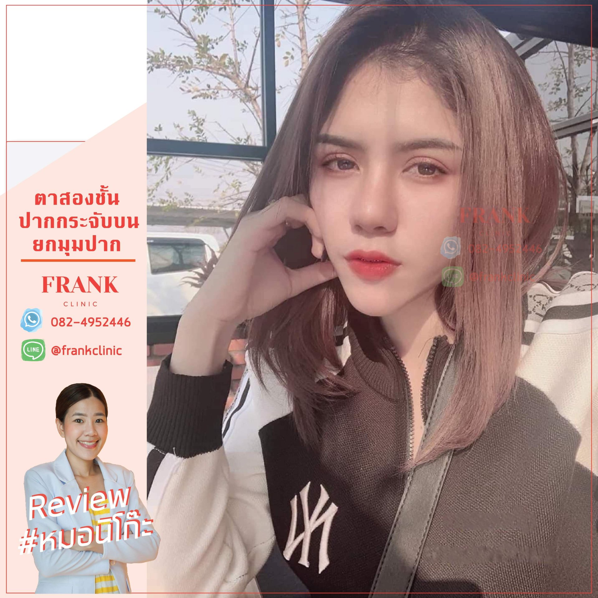 เจาะลึก 12 ข้อปฏิบัติหลังทำศัลยกรรมตาสองชั้น โดย หมอนิโกะ เจาะลึก 12 ข้อปฏิบัติหลังทำศัลยกรรมตาสองชั้น โดย หมอนิโกะ