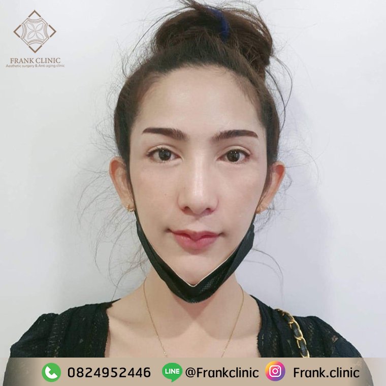 รีวิว คุณ รักกี้ สาวสวยเน็ตไอดอลมาแรง กับประสบการณ์แก้ปากกระจับที่สร้างความมั่นใจใหม่ในวันนี้ รีวิว คุณ รักกี้ สาวสวยเน็ตไอดอลมาแรง กับประสบการณ์แก้ปากกระจับที่สร้างความมั่นใจใหม่ในวันนี้