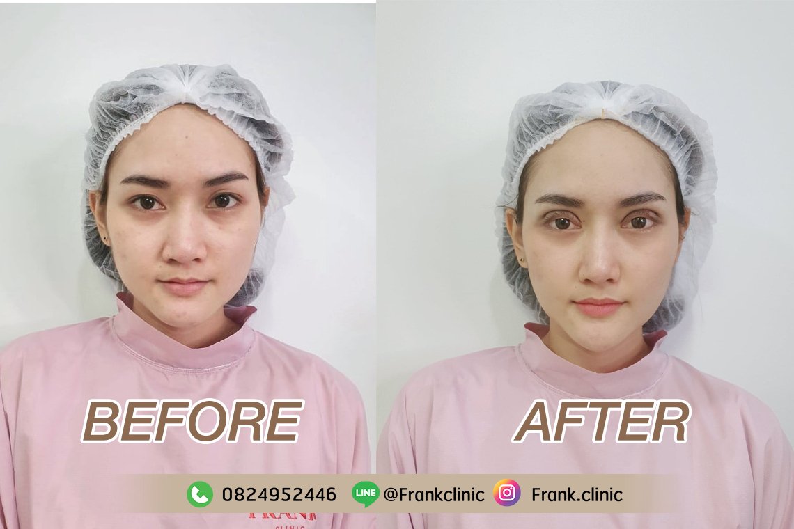 รีวิวจาก คุณตันหยง เปลี่ยนตาหมวย ให้เป็นสาวตาโตกลมแบ๊ว รีวิวจาก คุณตันหยง เปลี่ยนตาหมวย ให้เป็นสาวตาโตกลมแบ๊ว