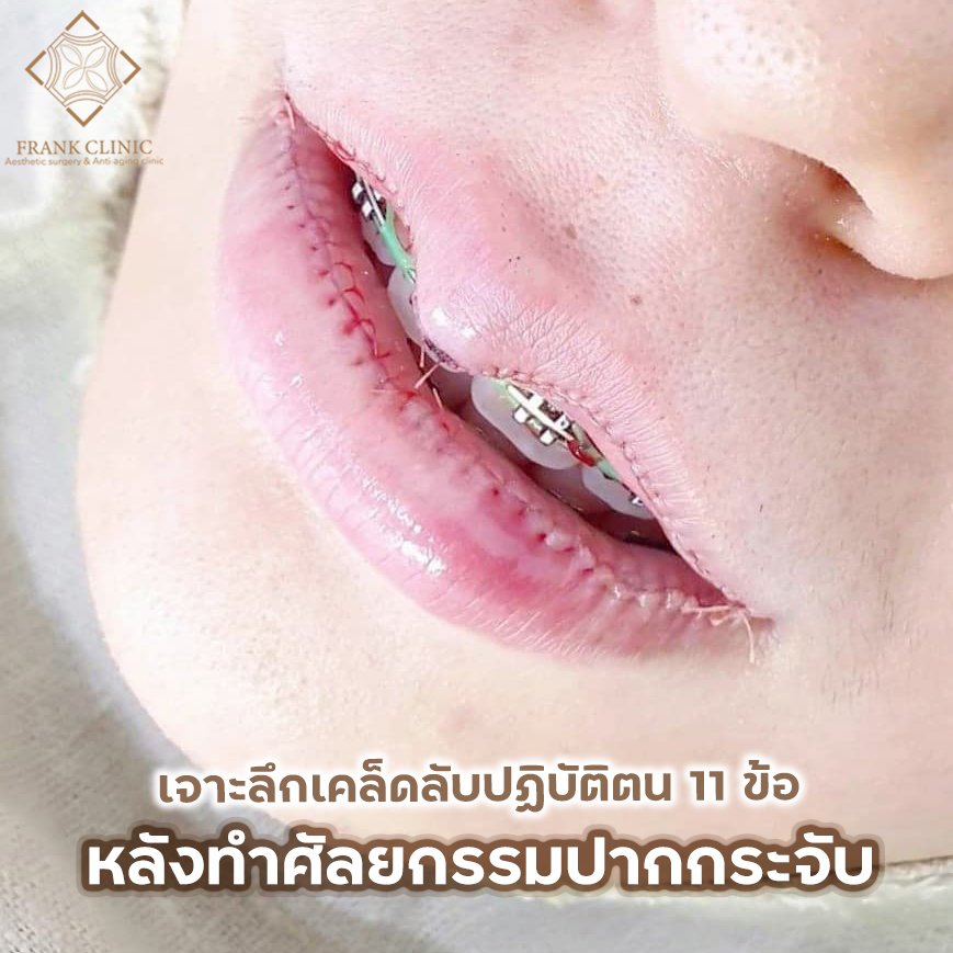 เจาะลึก 11 ข้อปฏิบัติหลังทำศัลยกรรมปากกระจับ โดย หมอนิโกะ เจาะลึก 11 ข้อปฏิบัติหลังทำศัลยกรรมปากกระจับ โดย หมอนิโกะ