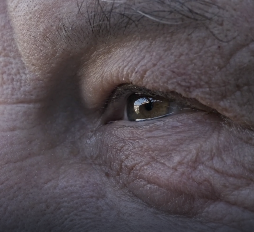 ถุงใต้ตาบวมใหญ่ แก้ด้วยฟิลเลอร์แล้วเป็นก้อน? ทำไมวัย 50+ ถึงควรเลือก ตัดถุงใต้ตาเทคนิค Eyelock แทน