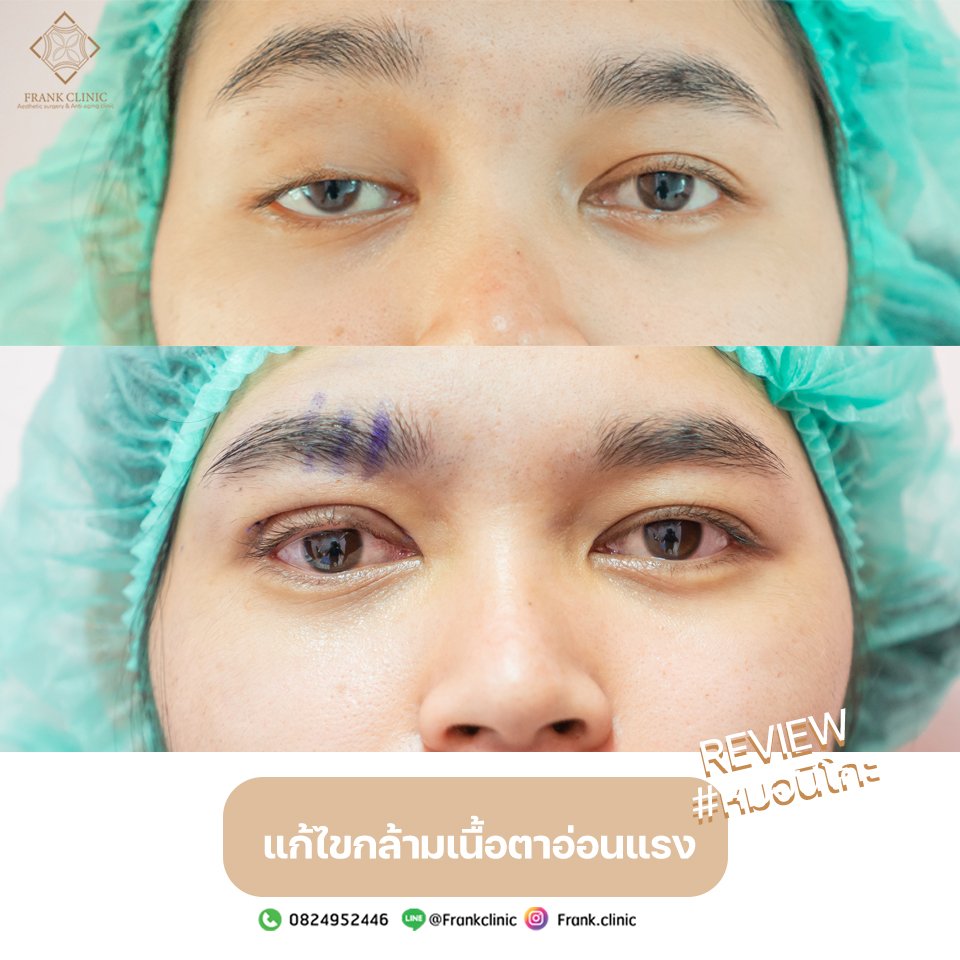 ภาวะกล้ามเนื้อตาอ่อนแรงคืออะไร ? ภาวะกล้ามเนื้อตาอ่อนแรงคืออะไร ?