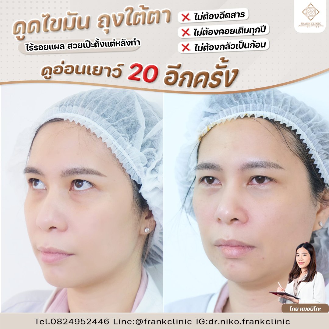 รีวิว ตัดถุงใต้ตา ไร้รอยแผล