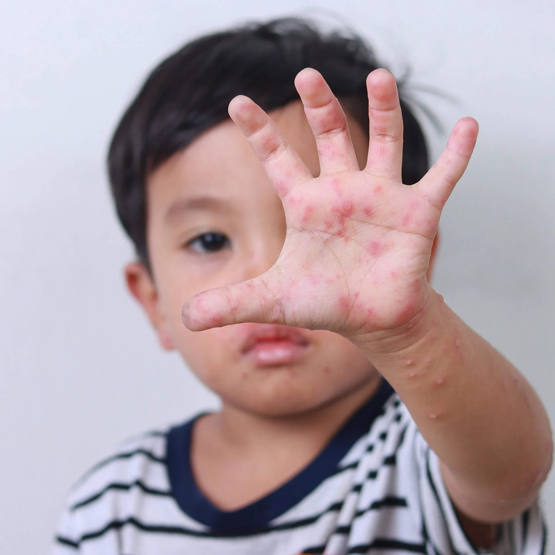 วัคซีนมือ เท้า ปาก วัคซีนมือ เท้า ปาก