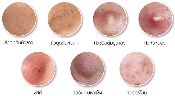 สิวอักเสบ เป็นหายยากแต่แก้ได้ I สิวหนอง I l สิวอักเสบ I สิ้วเรื้อรัง I สิวอุดตัน I ต้องคาวตองโปร 59 สิวอักเสบ เป็นหายยากแต่แก้ได้ I สิวหนอง I l สิวอักเสบ I สิ้วเรื้อรัง I สิวอุดตัน I ต้องคาวตองโปร 59