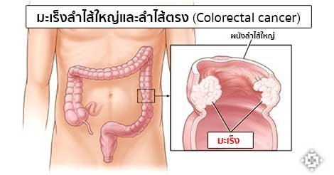 5 สัญญาณต่อไปนี้ เสี่ยงเป็นมะเร็งลำไส้ เช็คด่วนเลยคะ  ถ้าหากมี 5 อาการนี้เสี่ยงเป็นมะเร็งลำไส้!  5 สัญญาณต่อไปนี้ เสี่ยงเป็นมะเร็งลำไส้ เช็คด่วนเลยคะ  ถ้าหากมี 5 อาการนี้เสี่ยงเป็นมะเร็งลำไส้!
