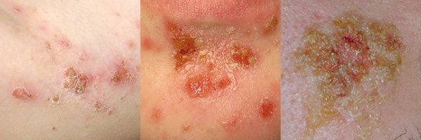 ภาวะน้ำเหลืองไม่ดีคืออะไร ภาวะน้ำเหลืองไม่ดีคืออะไร