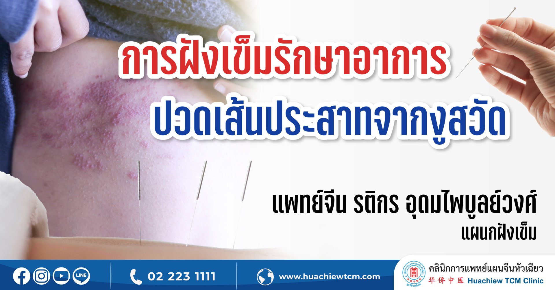 การฝังเข็มรักษาอาการปวดเส้นประสาทจากงูสวัด
