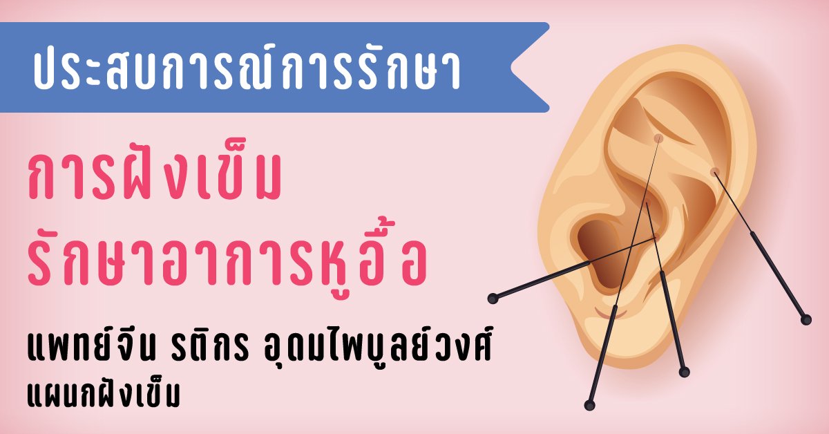 การฝังเข็มรักษาอาการหูอื้อ